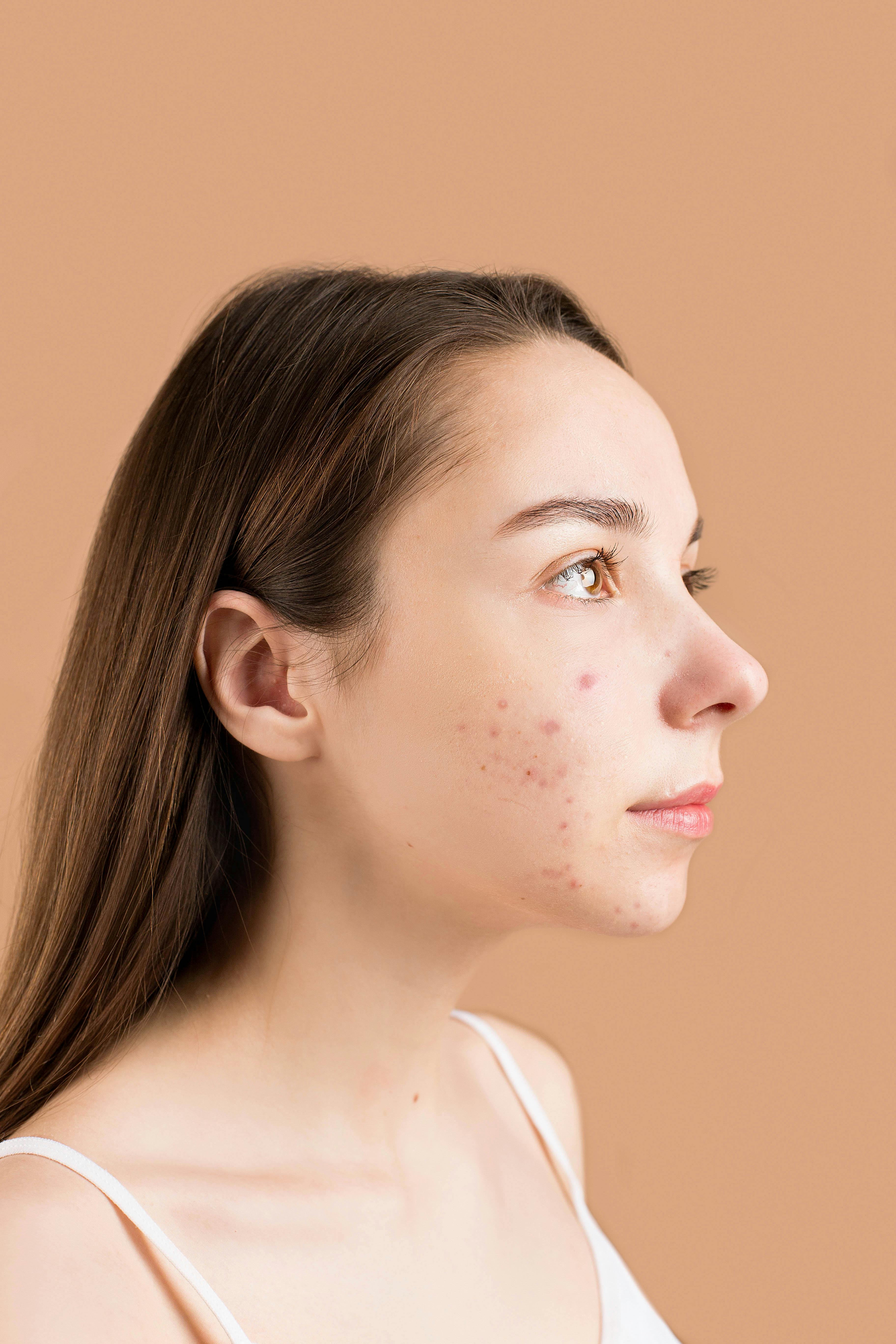 Acne-Prone Skin